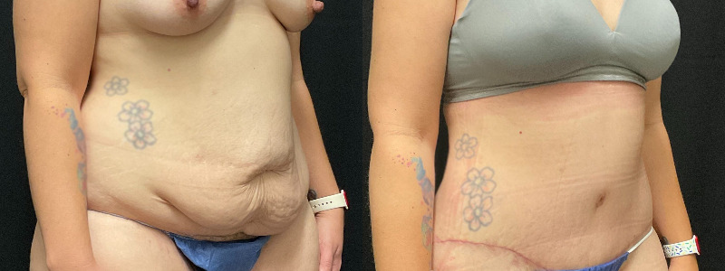 before and after tummy tuck