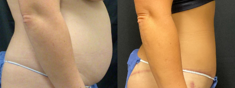before and after tummy tuck
