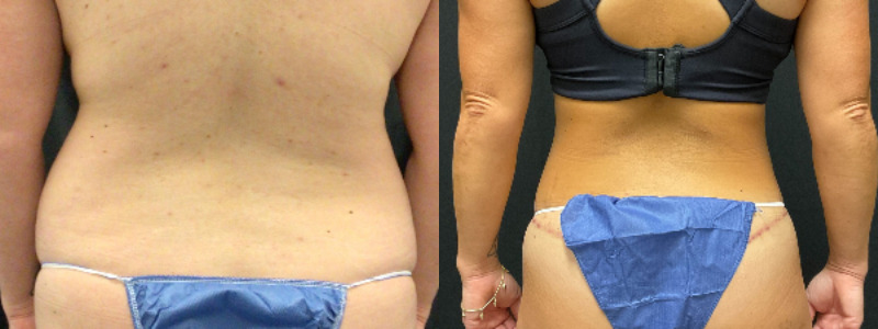 before and after tummy tuck