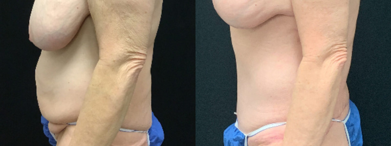 before and after tummy tuck