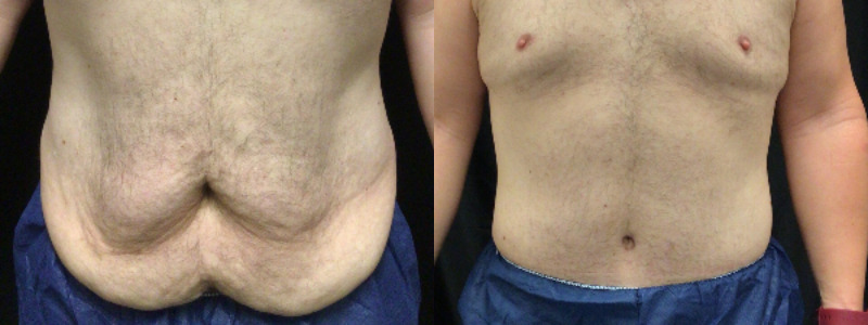 before and after tummy tuck