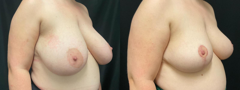 before and after breast reduction