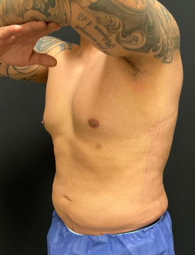 after liposuction