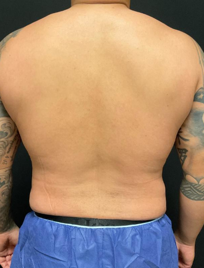 after liposuction