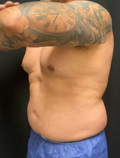 before liposuction