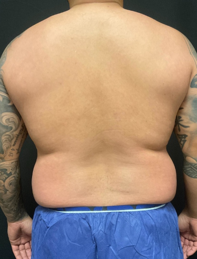 before liposuction