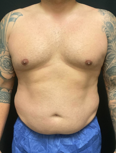 before liposuction