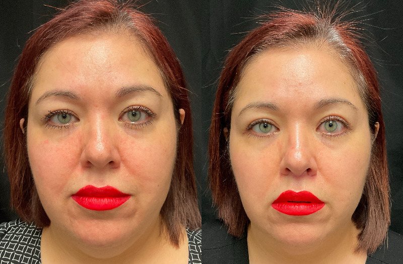 before and after eyelid surgery