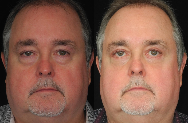 before and after eyelid surgery