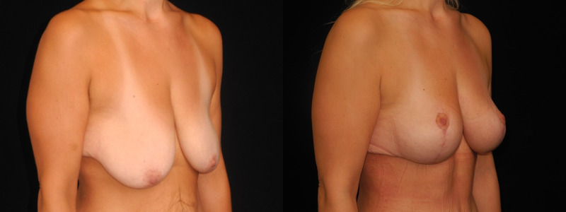 before and after breast lift