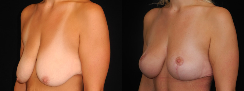 before and after breast lift