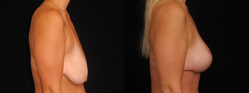before and after breast lift
