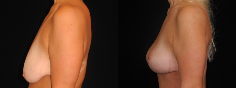 before and after breast lift