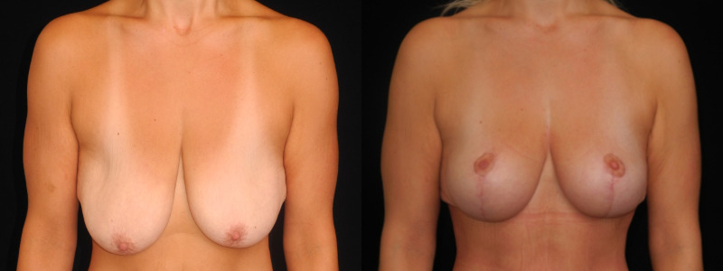 before and after breast lift