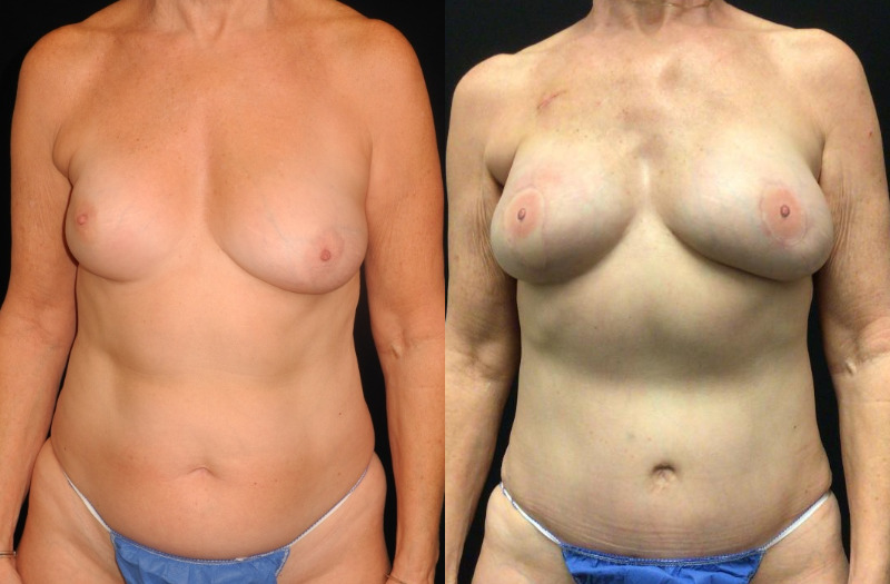 before and after diep flap reconstruction