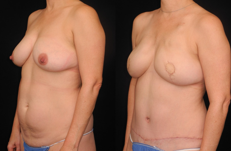 before and after diep flap reconstruction