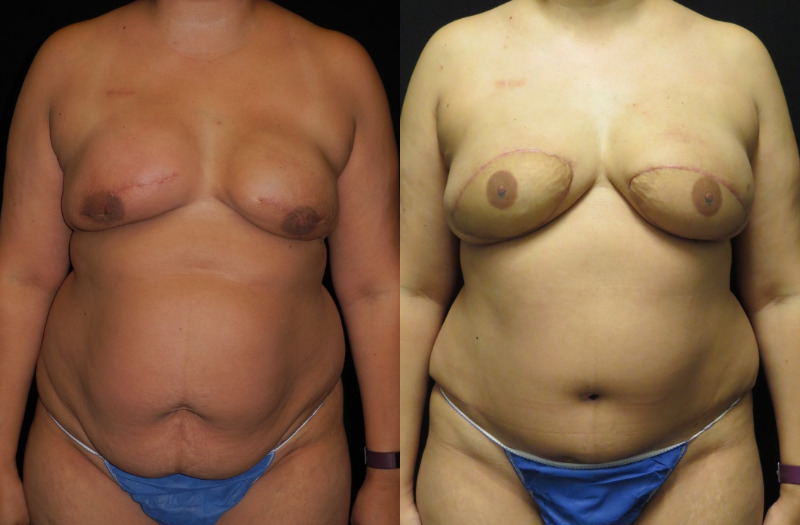 before and after diep flap reconstruction