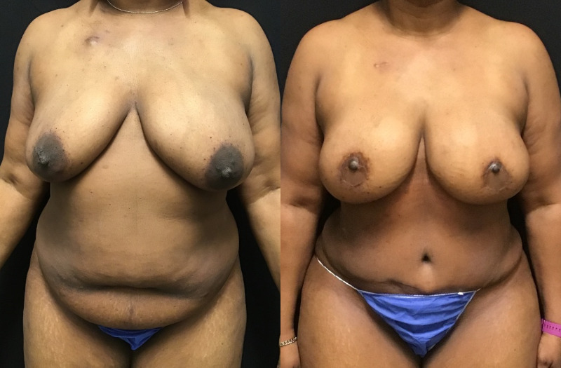 before and after diep flap reconstruction