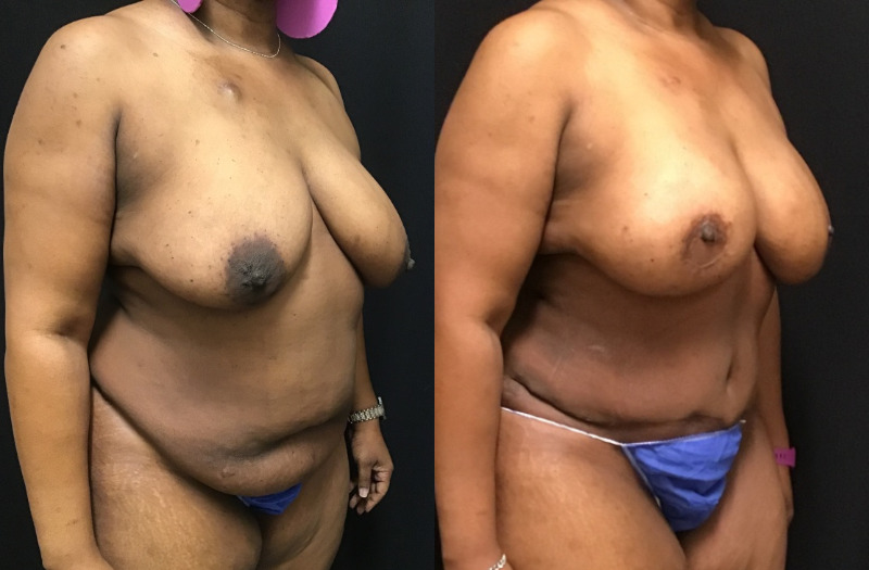 before and after diep flap reconstruction