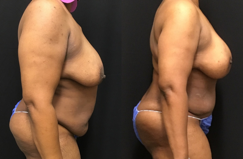 before and after diep flap reconstruction