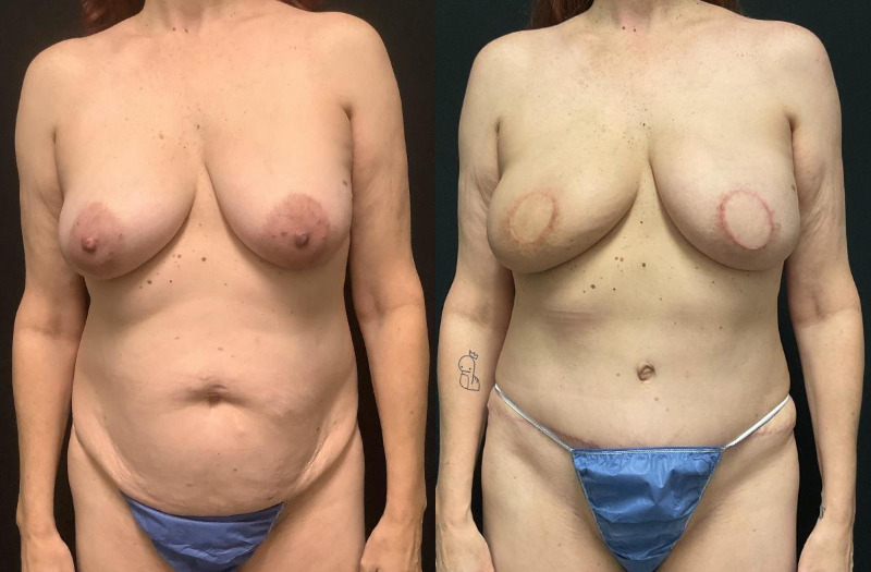 before and after diep flap reconstruction