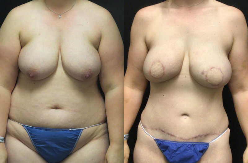 before and after diep flap reconstruction