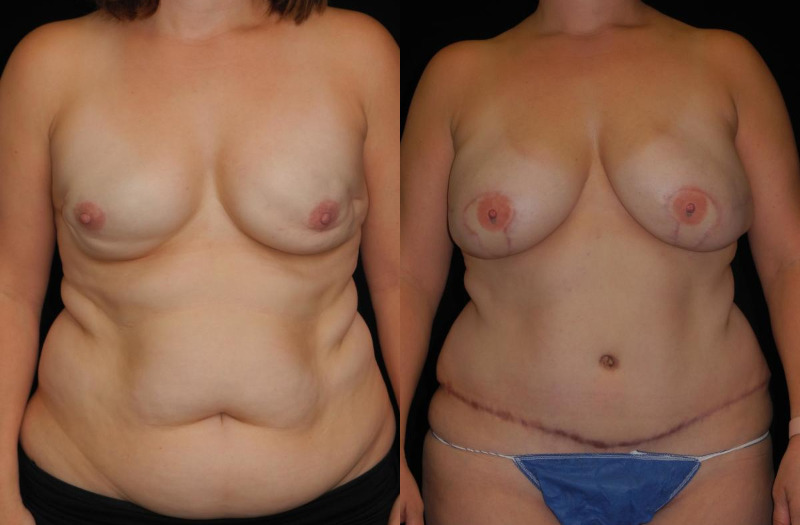 before and after diep flap reconstruction