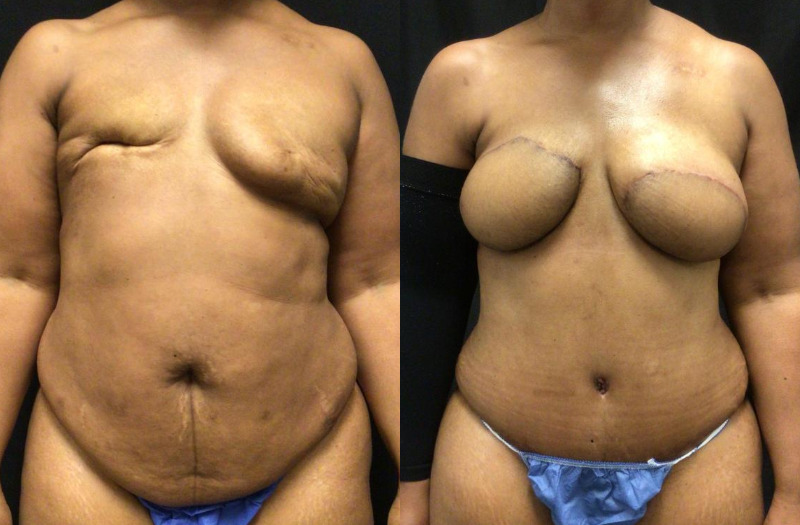 before and after diep flap reconstruction