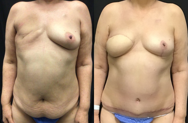 before and after diep flap reconstruction