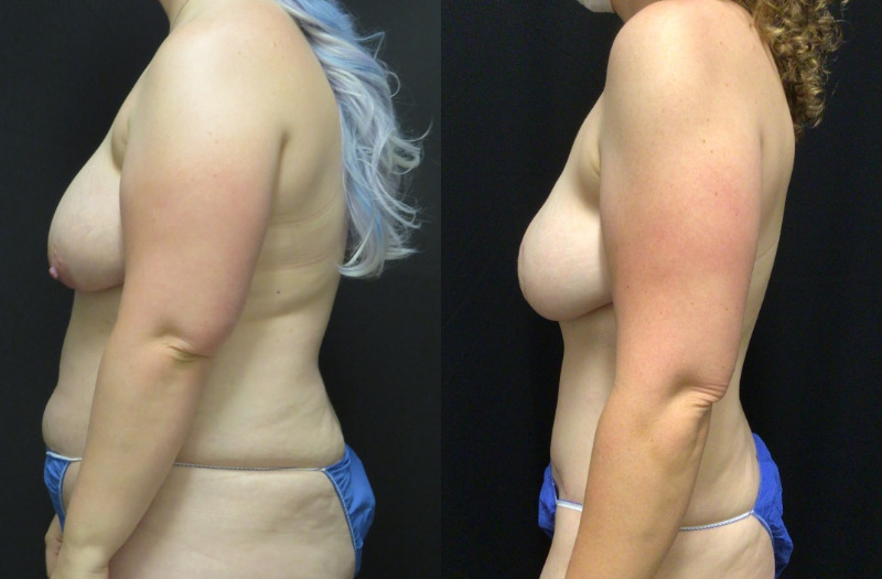 before and after diep flap reconstruction