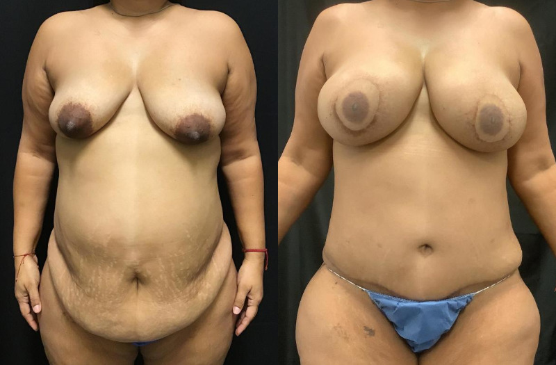 before and after diep flap reconstruction