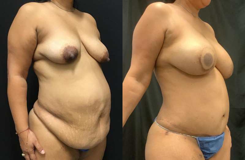before and after diep flap reconstruction