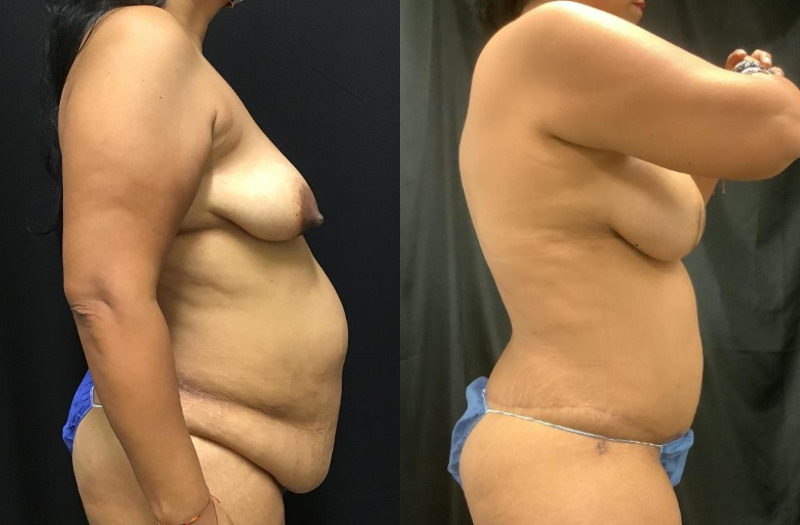 before and after diep flap reconstruction