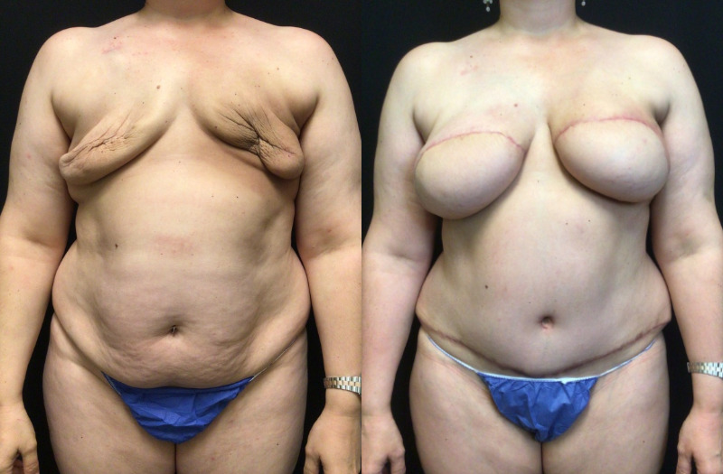 before and after diep flap reconstruction