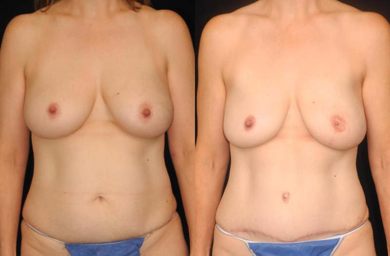 before and after diep flap reconstruction