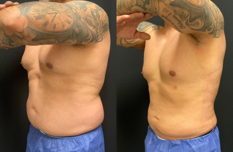 before and after liposuction
