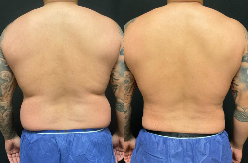 before and after liposuction