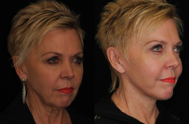 before and after neck lift