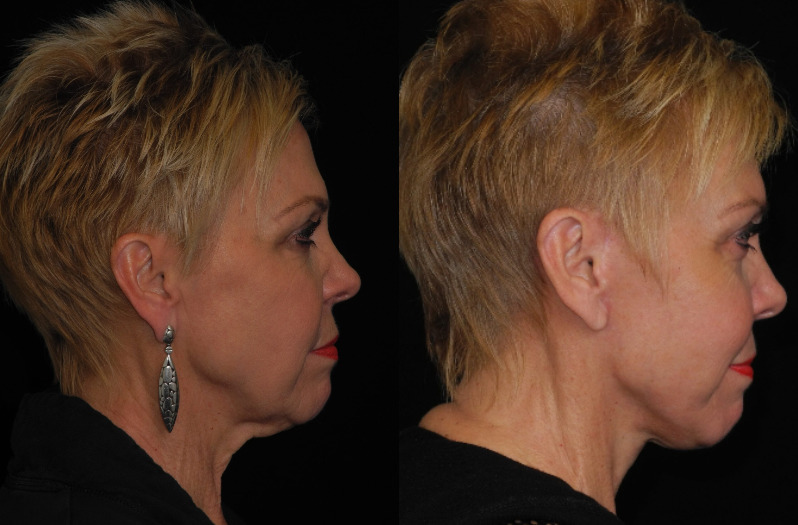 before and after neck lift