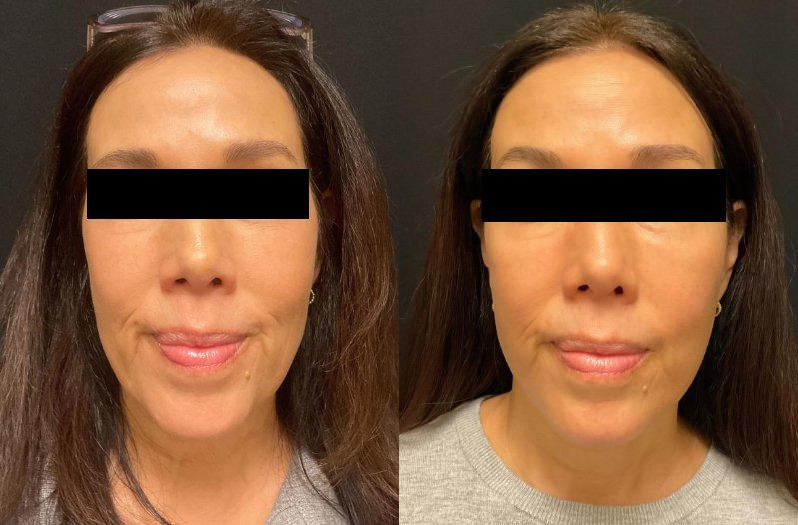 before and after neck lift