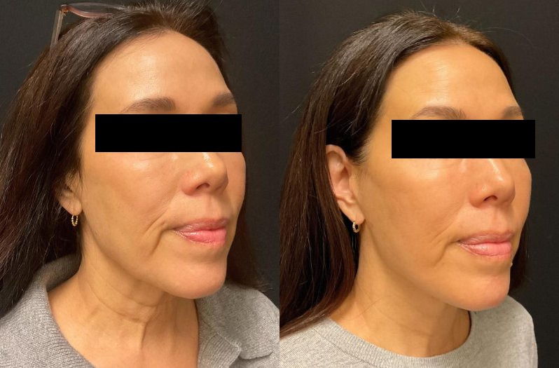before and after neck lift