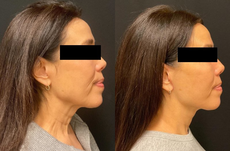 before and after neck lift