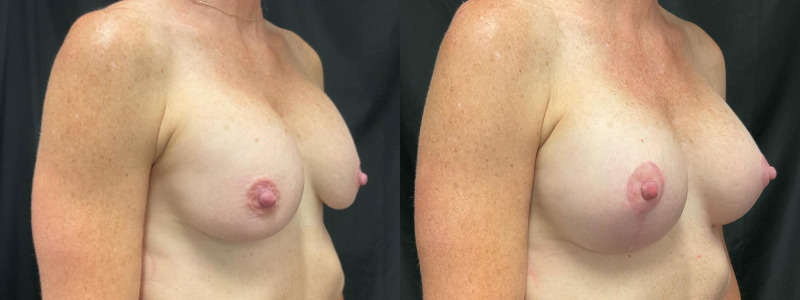 before and after breast augmentation with lift
