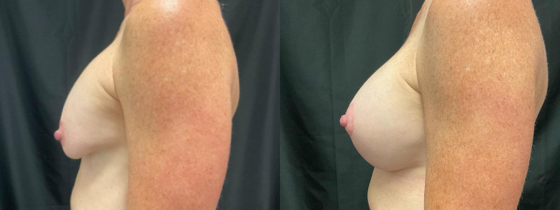 before and after breast augmentation with lift