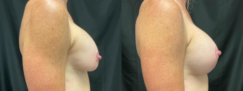 before and after breast augmentation with lift