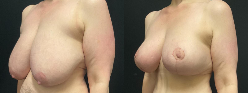 before and after breast reduction