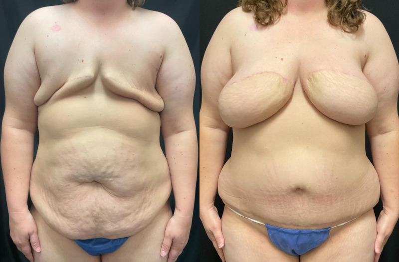before and after diep flap reconstruction