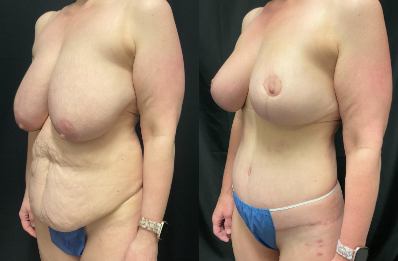 before and after mommy makeover