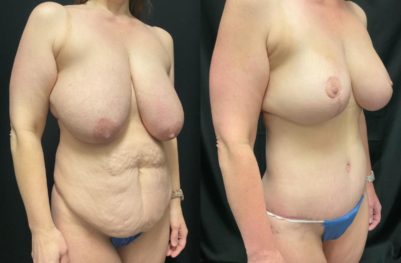 before and after mommy makeover
