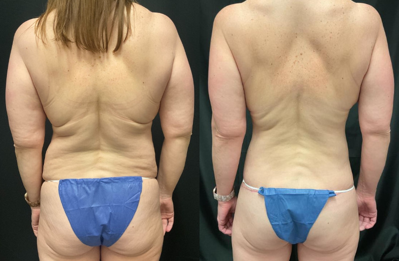 before and after mommy makeover